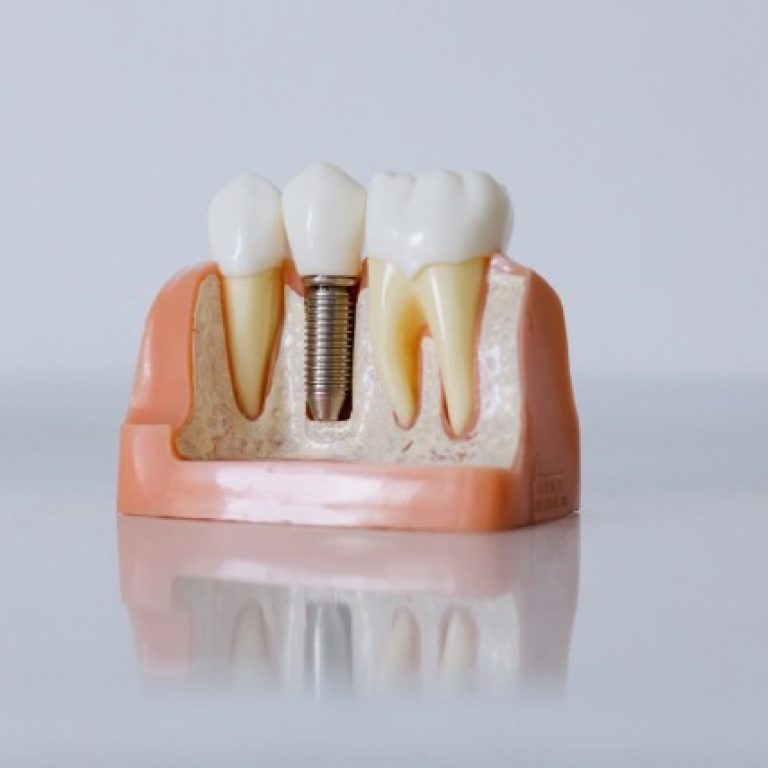 implantat-blog Medium